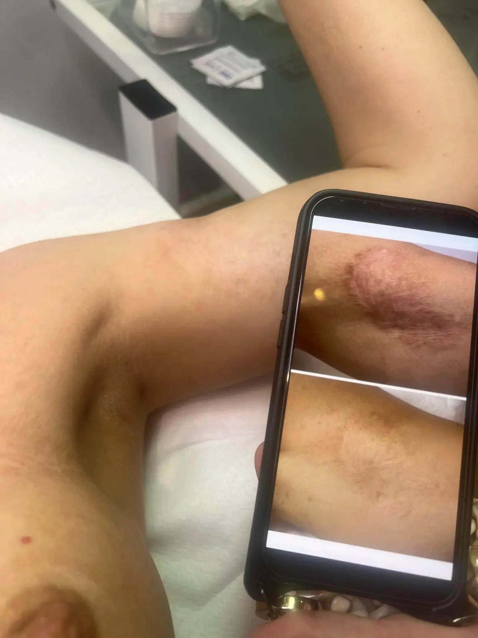 Dokumentation av ScarNik-resultat på arm
